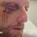 Stokes has successful surgery on broken cheek